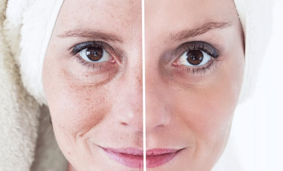 Rexuvenecemento facial con láser